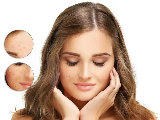 những câu nói về mụn