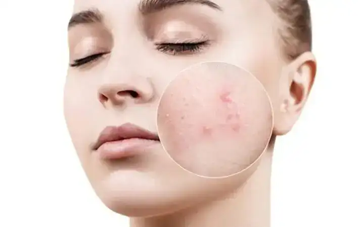 những câu nói về mụn